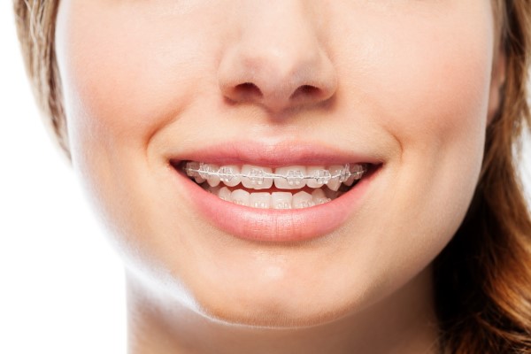 Clear Braces: A Discreet Way To Straighten Your Smile