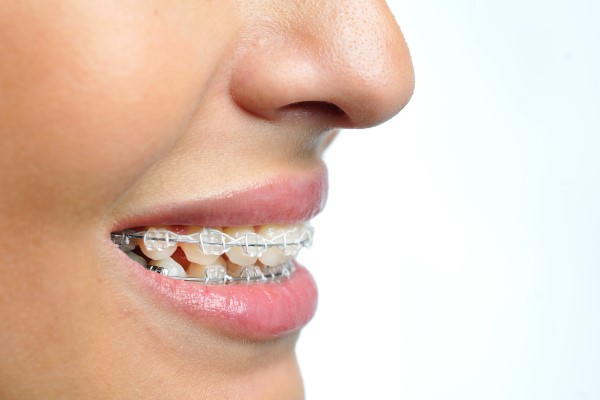 Clear Differences Between Clear Braces And Clear Aligners