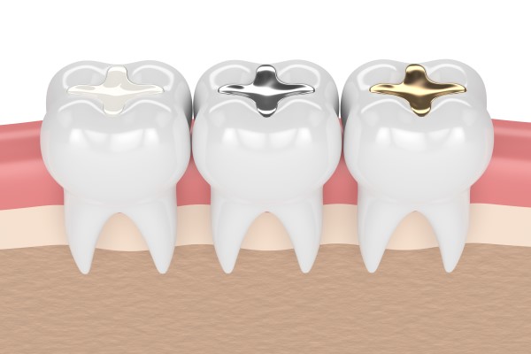 Types Of Dental Fillings And How To Choose The Right One