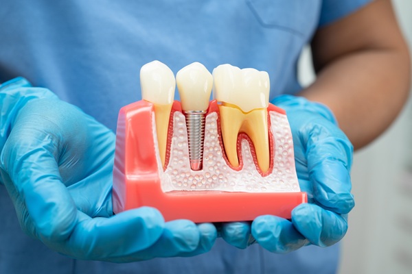The Process Of Dental Implants: From Bone Grafting To Tooth Replacement