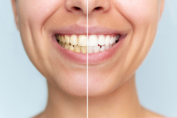 Professional Teeth Whitening Vs  At Home Kits: What Works Best?